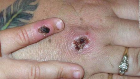 ¿Qué síntomas causa la mpox o viruela del mono, cómo se contagia y qué sabemos de ella? imagen-13