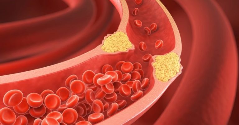 Colesterol alto: advierten por una recomendación que se cumple poco y que evitaría muchos infartos prematuros imagen-5