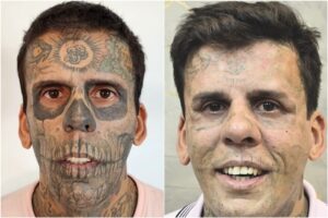 Es el hombre más tatuado de Brasil, decidió borrarse todo y cuenta el calvario que vive: “El dolor es horrible” imagen-1