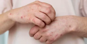 Las señales invisibles del lupus y cómo tratarlo adecuadamente imagen-3