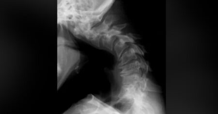 En un hospital atendieron un raro caso de síndrome de cabeza caída imagen-13