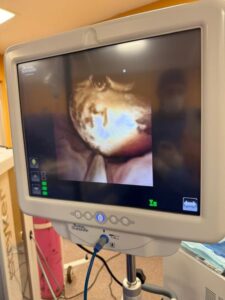 Pediátrico: se realizó cirugía urológica mínimamente invasiva en paciente con litiasis ureteral imagen-79