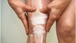 Los 6 antiinflamatorios naturales que se pueden usar para terminar con el dolor de rodilla imagen-1