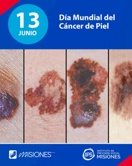 ☀️ 13 de junio – Día Mundial del Cáncer de Piel 🧴 imagen-5