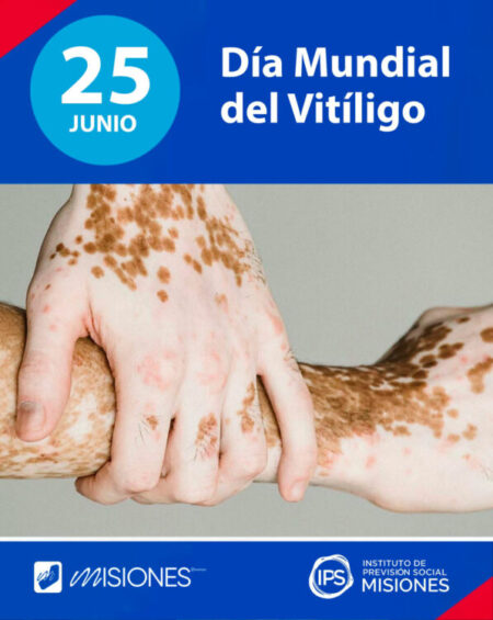 📒25 de junio: 🌎Se conmemora el Día Mundial del VITILIGO imagen-77