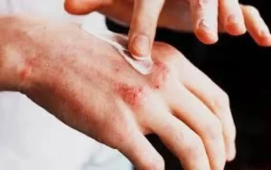 Misiones se suma a la campaña nacional para la detección de la dermatitis atópica imagen-2
