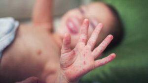 Salud descarta casos de sarampión en Misiones y emite alerta preventiva imagen-2