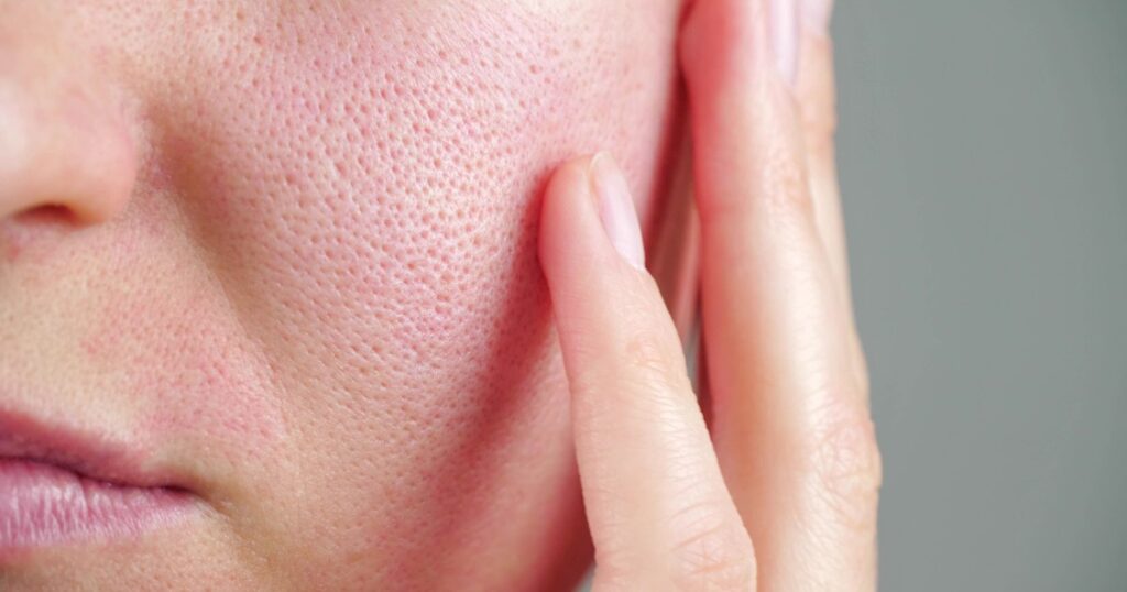Sabañones, rosácea, dermatitis, todo empeora con el frío: 10 consejos para cuidar la piel en invierno imagen-5