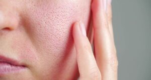 Sabañones, rosácea, dermatitis, todo empeora con el frío: 10 consejos para cuidar la piel en invierno imagen-1