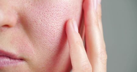 Sabañones, rosácea, dermatitis, todo empeora con el frío: 10 consejos para cuidar la piel en invierno imagen-7