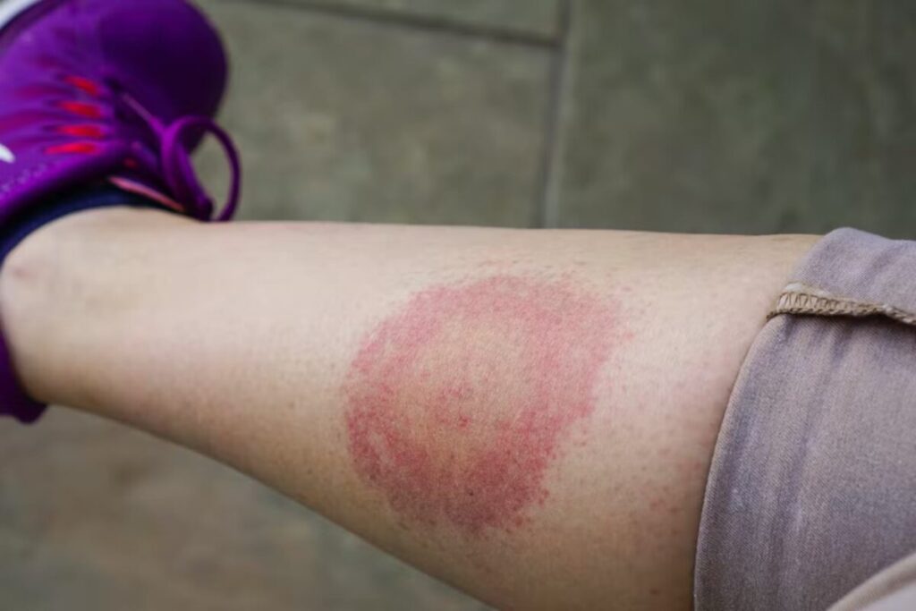Qué es la enfermedad de Lyme, la patología que tiene Justin Timberlake imagen-5