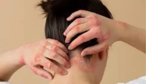 Misiones se suma a la campaña gratuita de detección de psoriasis imagen-2