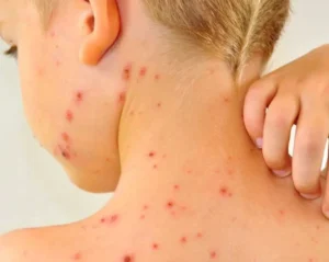 Casos de positivos de varicela: especialistas recomiendan la vacunación en niños imagen-2