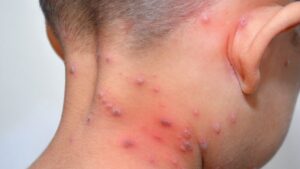 Recomiendan reforzar la vacunación infantil ante el aumento de casos de varicela imagen-1