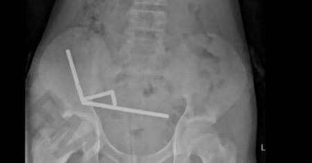 Un adolescente se tragó casi 200 imanes que compró por internet y perdió parte de su intestino imagen-22
