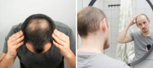 La calvicie no es solo genética: estas son las principales razones por las que se le puede estar cayendo el cabello imagen-2
