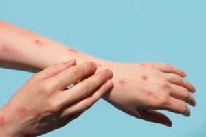 Misiones refuerza controles y vacunación ante brote de sarampión en Paraguay imagen-4