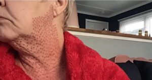 Mala praxis: "me operé de la papada y parezco un pollo desplumado" imagen-2