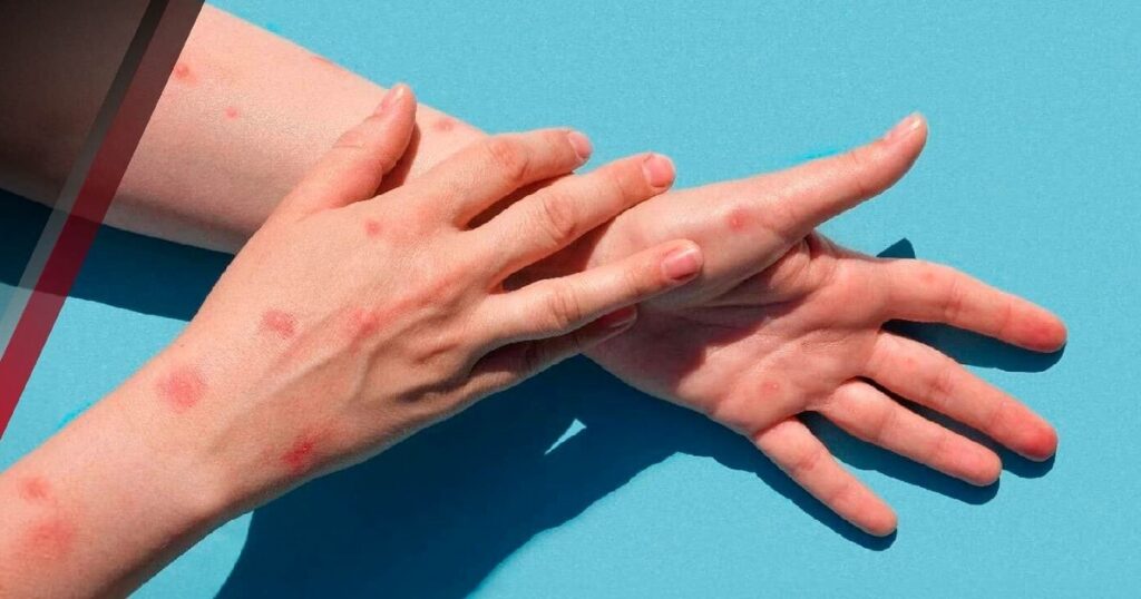 Alerta en California: confirmaron el primer caso autóctono de EEUU de la variante más severa del virus mpox imagen-4