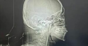 Un hombre vivió 8 años con un palillo de metal atascado en la garganta imagen-2