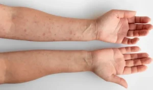 Sífilis: los casos continúan en aumento en Misiones y el país Sífilis: los casos continúan en aumento en Misiones y el país imagen-1